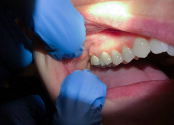 Best Emergency Treatment for Dental Infections or Abscesses in Blue Mound, TX