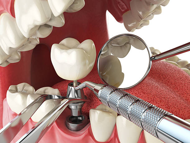 Best Emergency Tooth Extraction in Blue Mound, TX